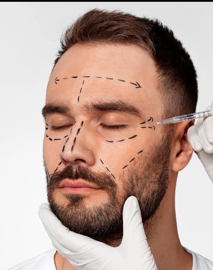 Face Thread Lift and Nose Thread Lift