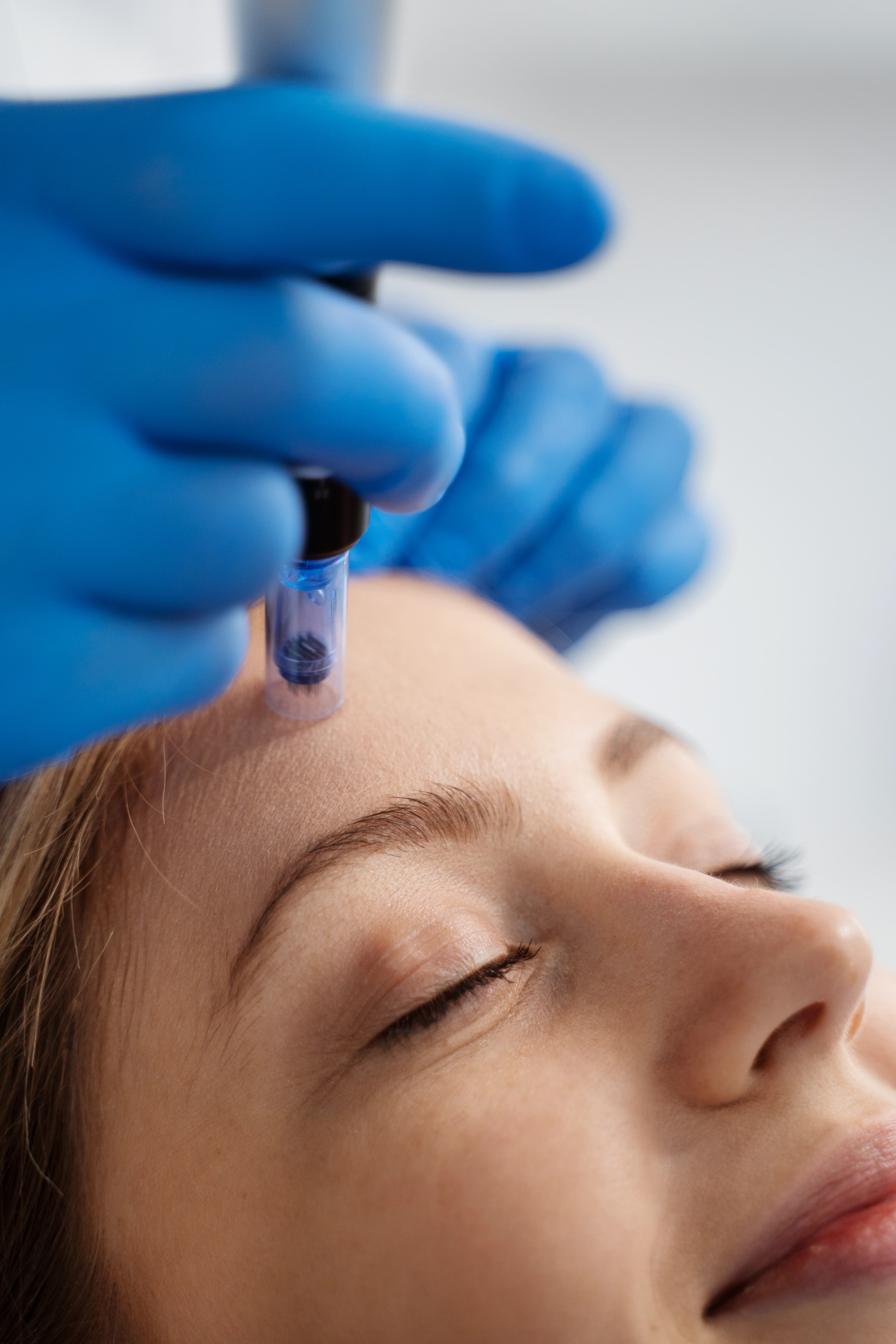 Micro Needling treatment