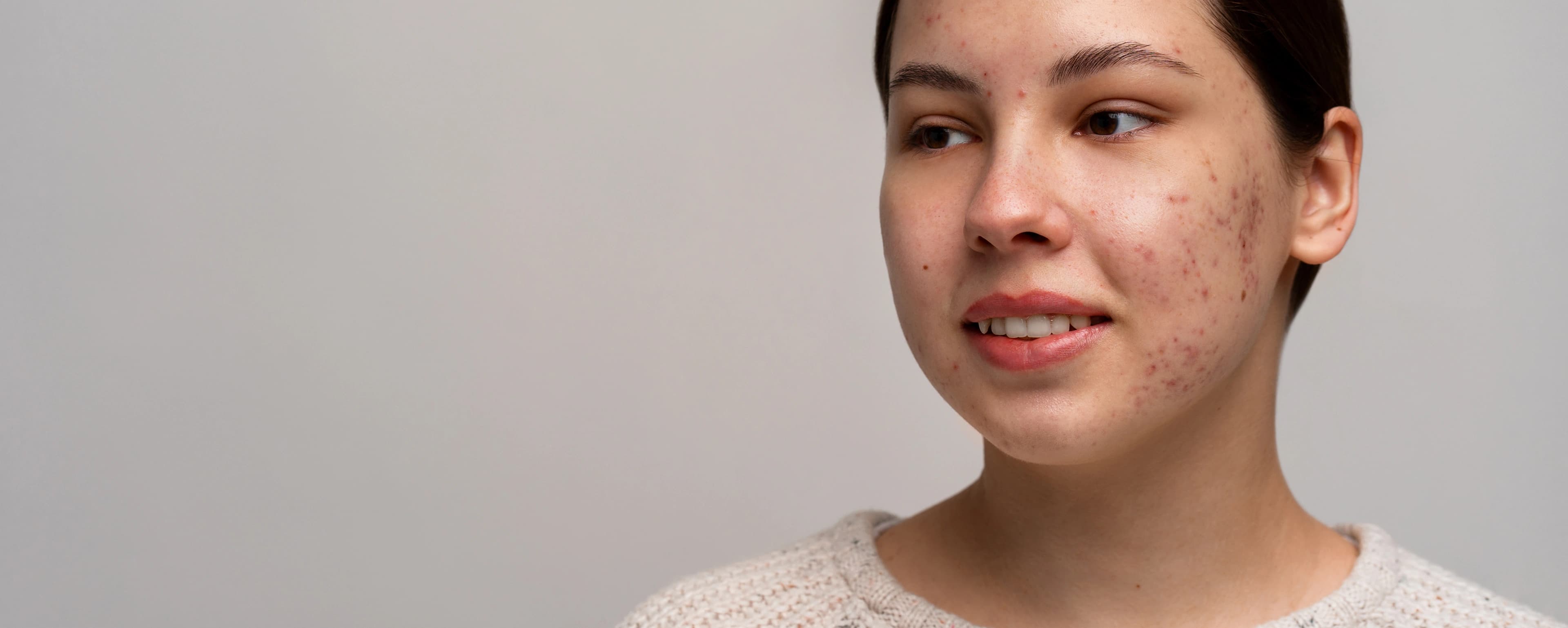 Acne Treatment Solutions