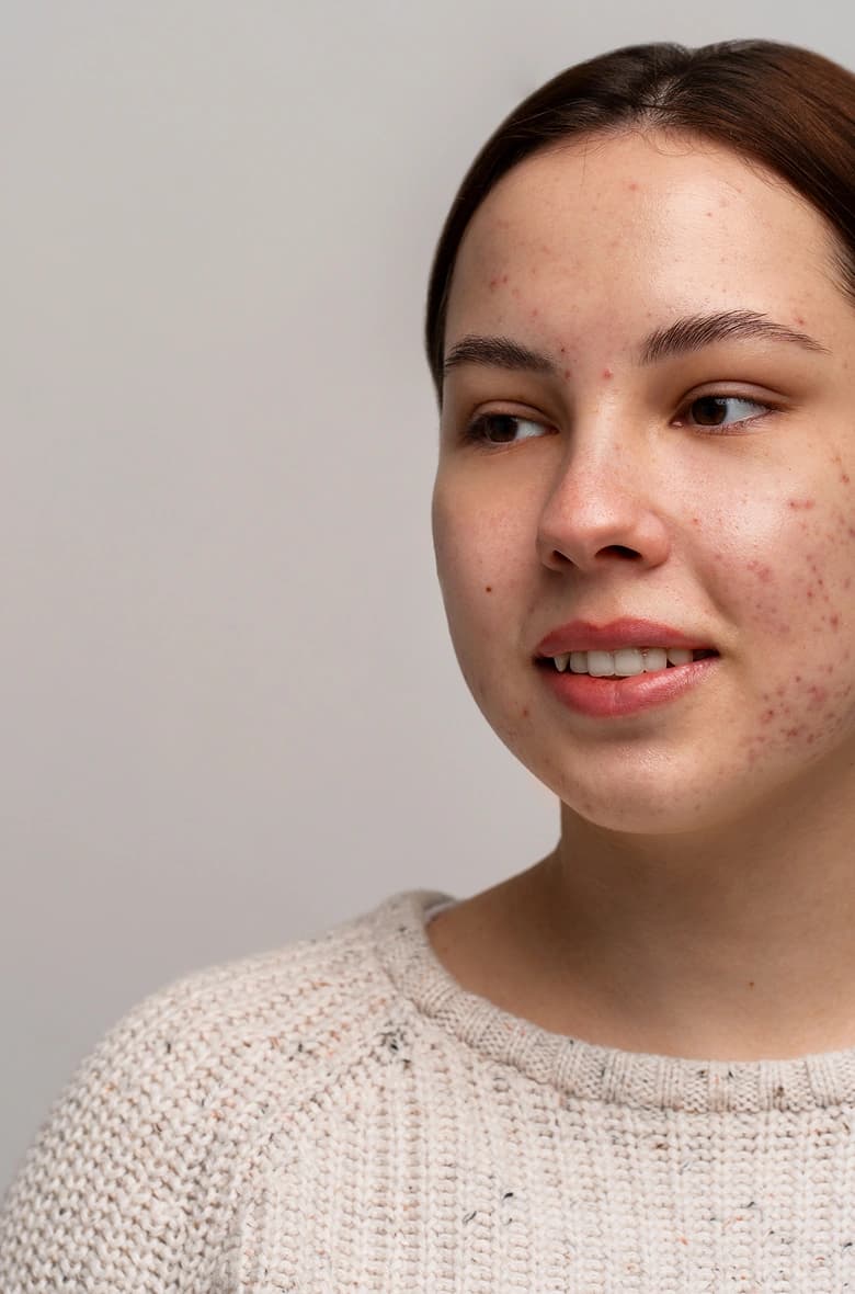 Acne Treatment Solutions