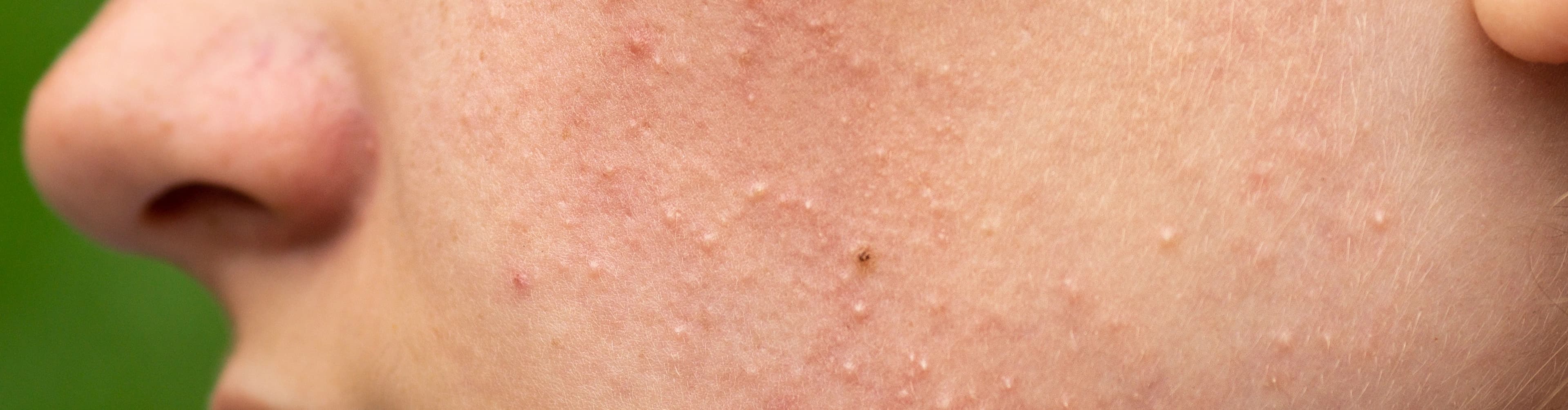 Types of Acne