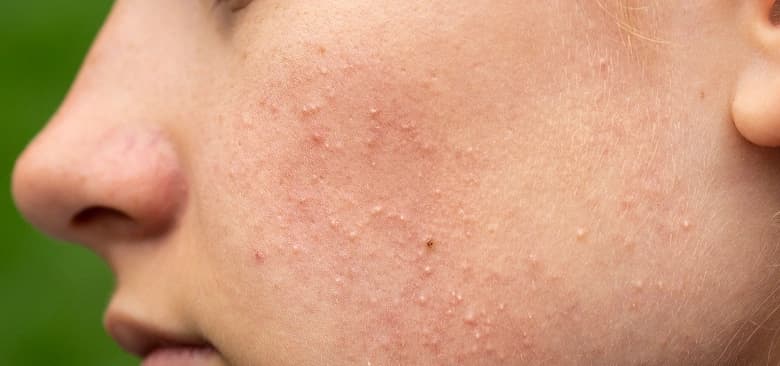 Types of Acne