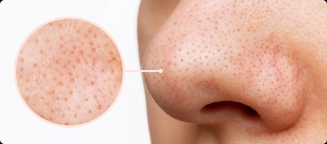 Whiteheads & Blackheads