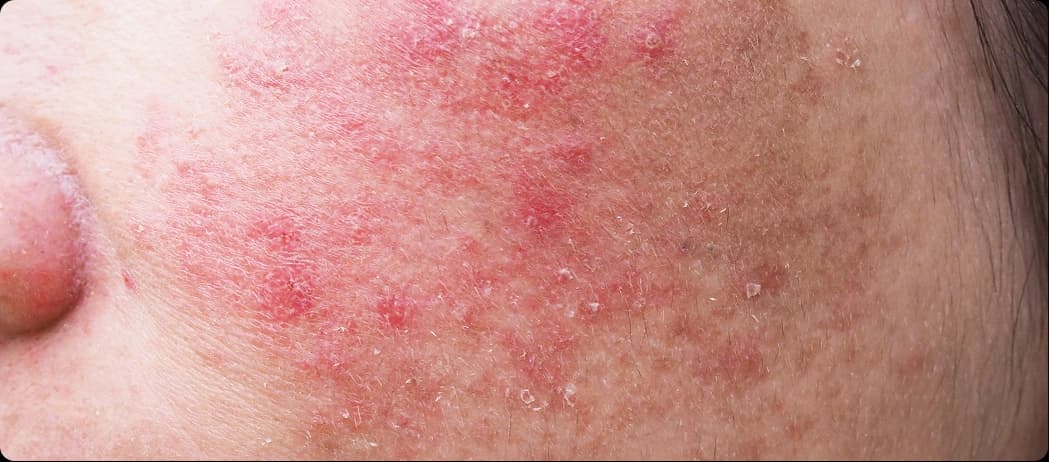 Papules & Pustules