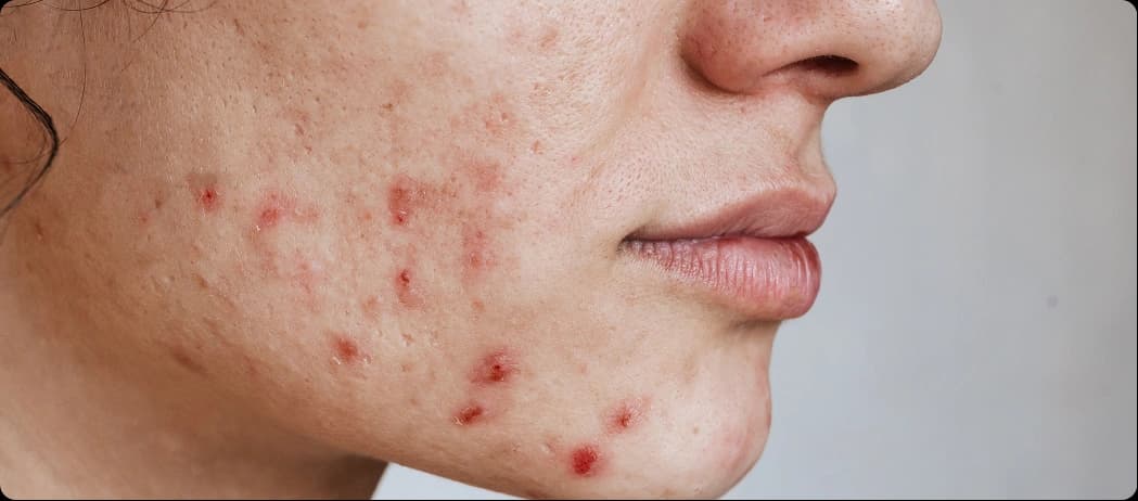Hormonal Acne