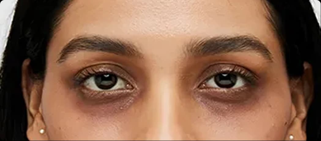 Pigmented Dark Circles