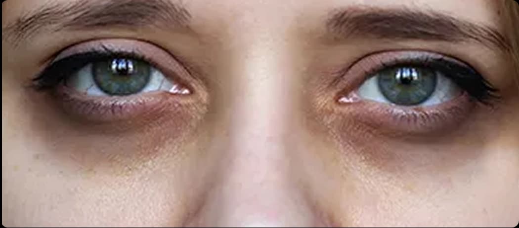 Dark Circles Due to Allergy