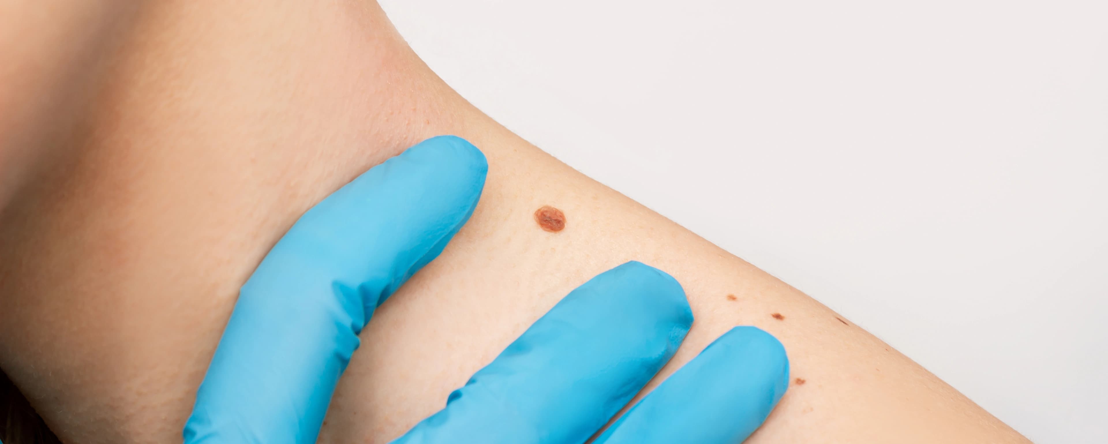 Mole Removal Treatment