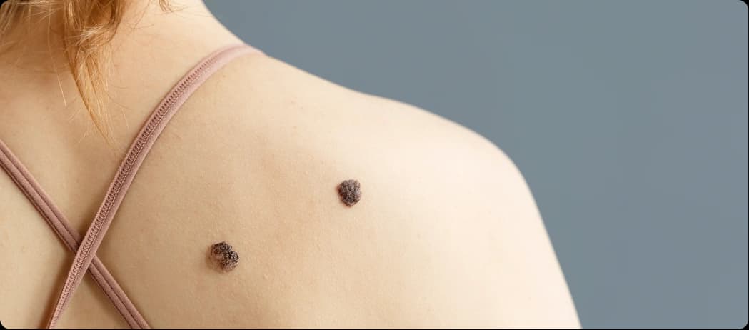 Raised or Black Moles