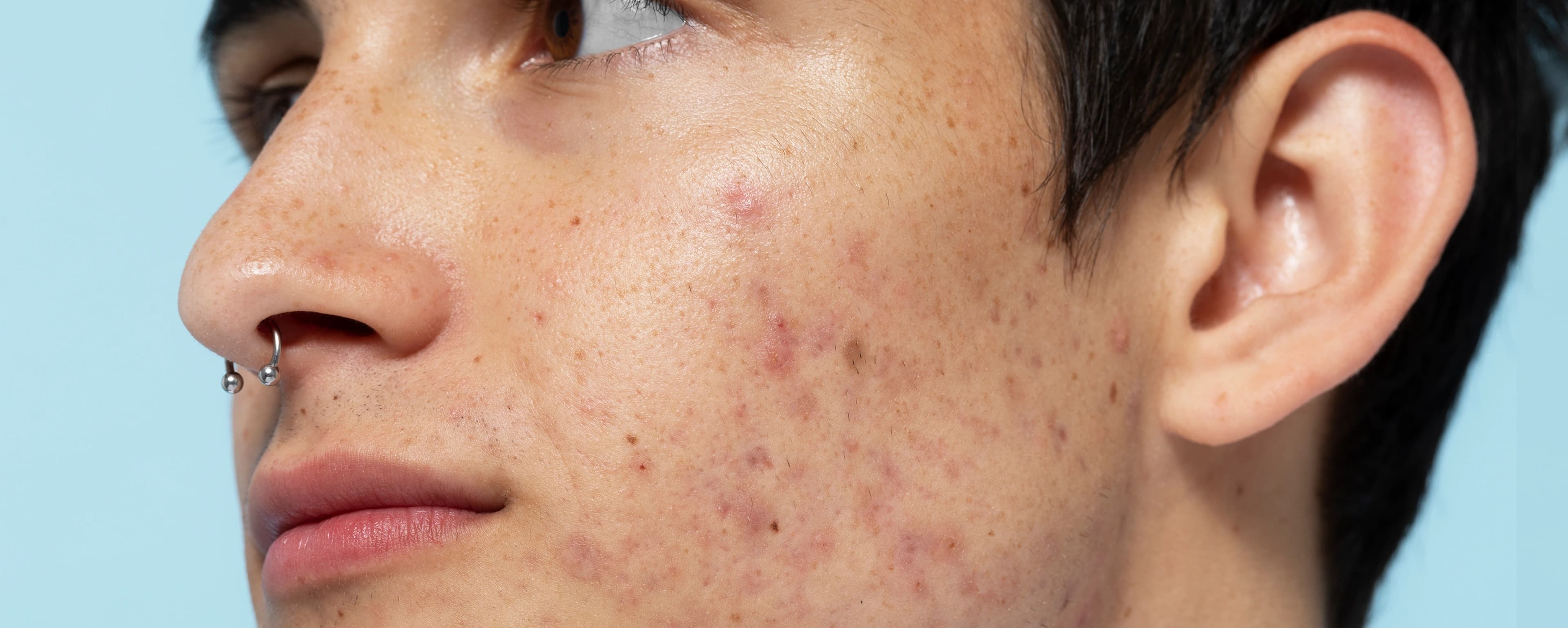 Pigmentation Treatment