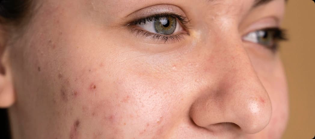 Melasma