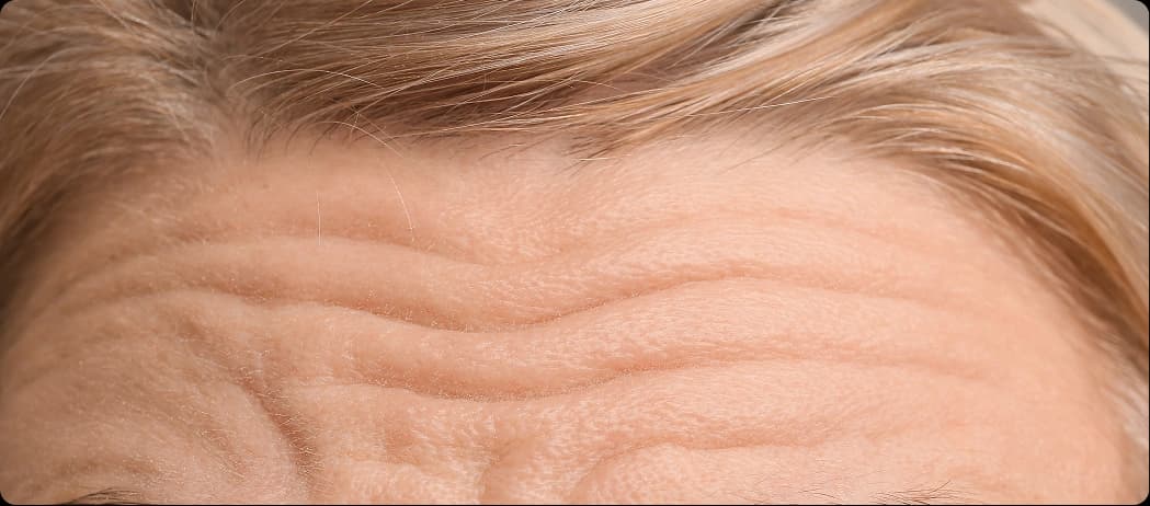 Forehead Lines