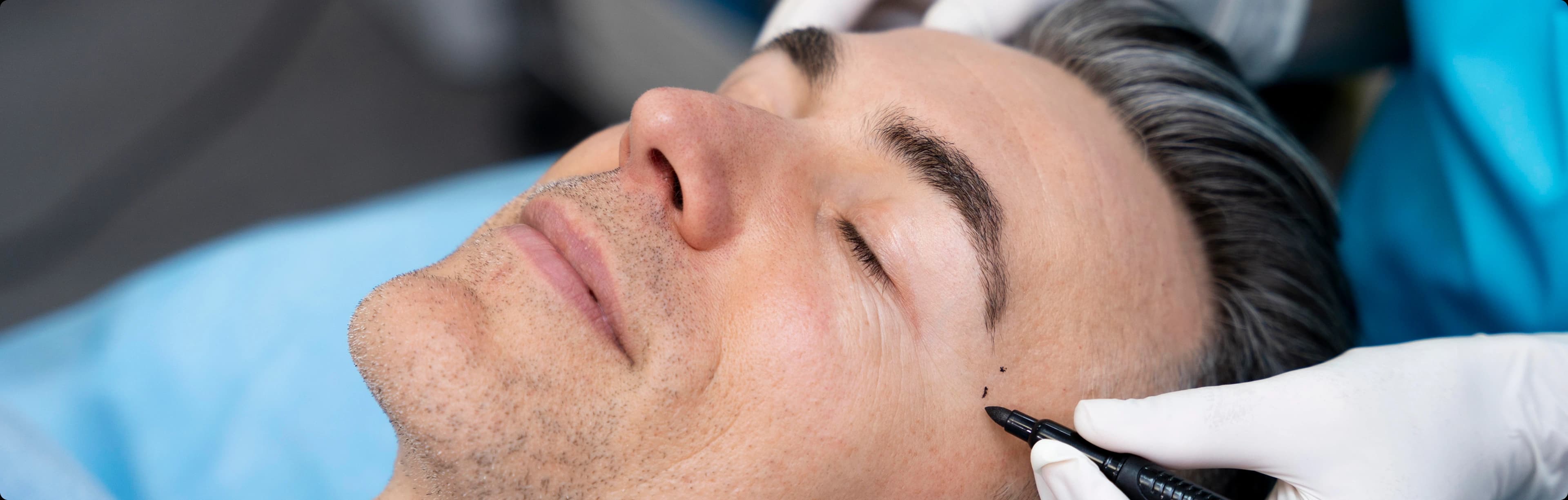 Facial Hair Transplant Procedure