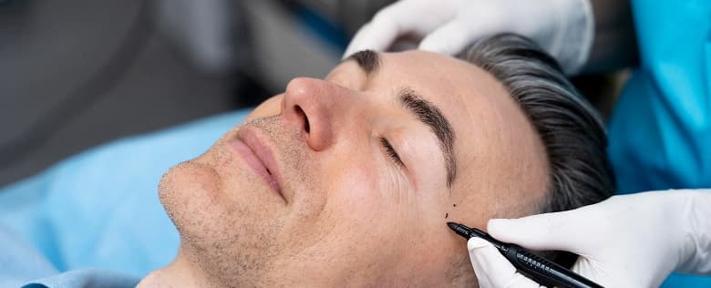 Facial Hair Transplant Procedure
