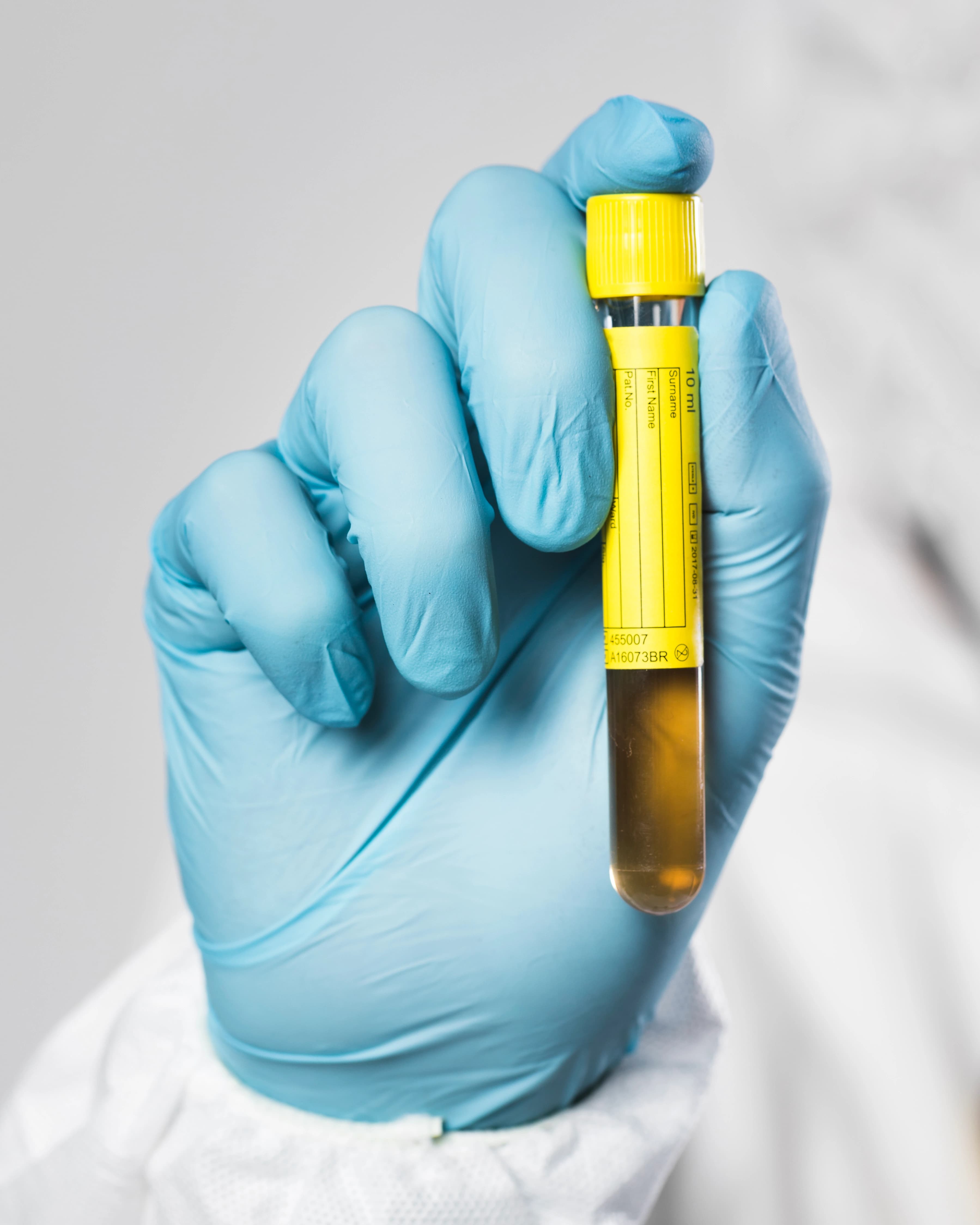 Platelet Rich Plasma treatment