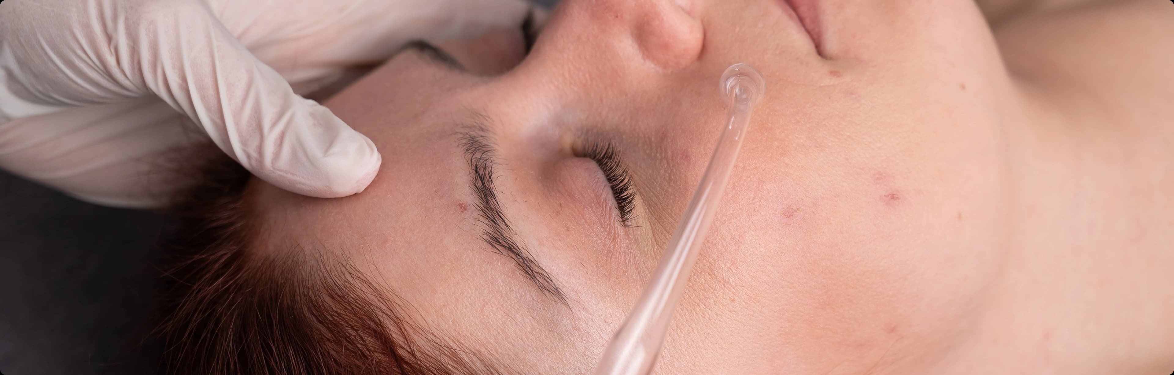 Chemical peel treatment