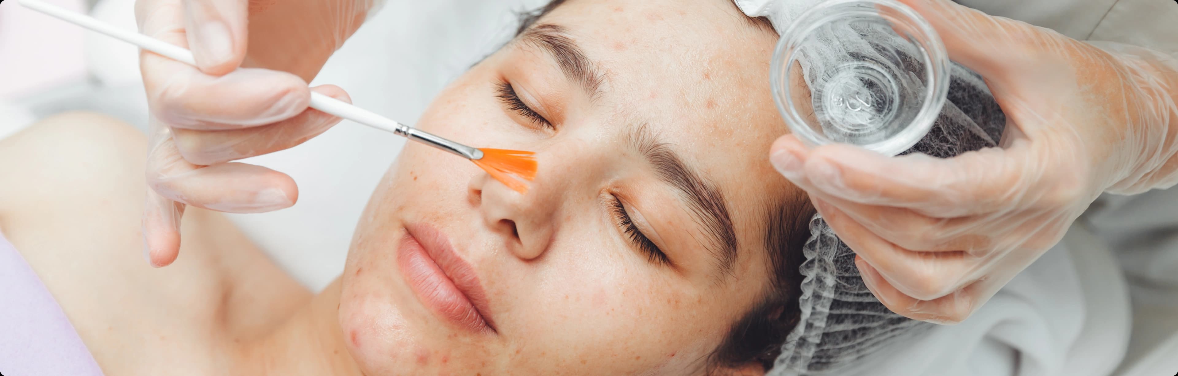 Chemical peel results