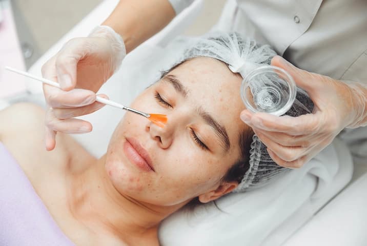 Chemical peel results