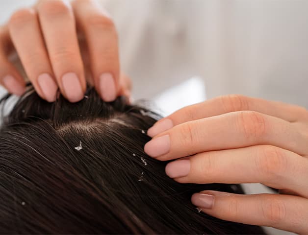 Scalp Peel Treatment