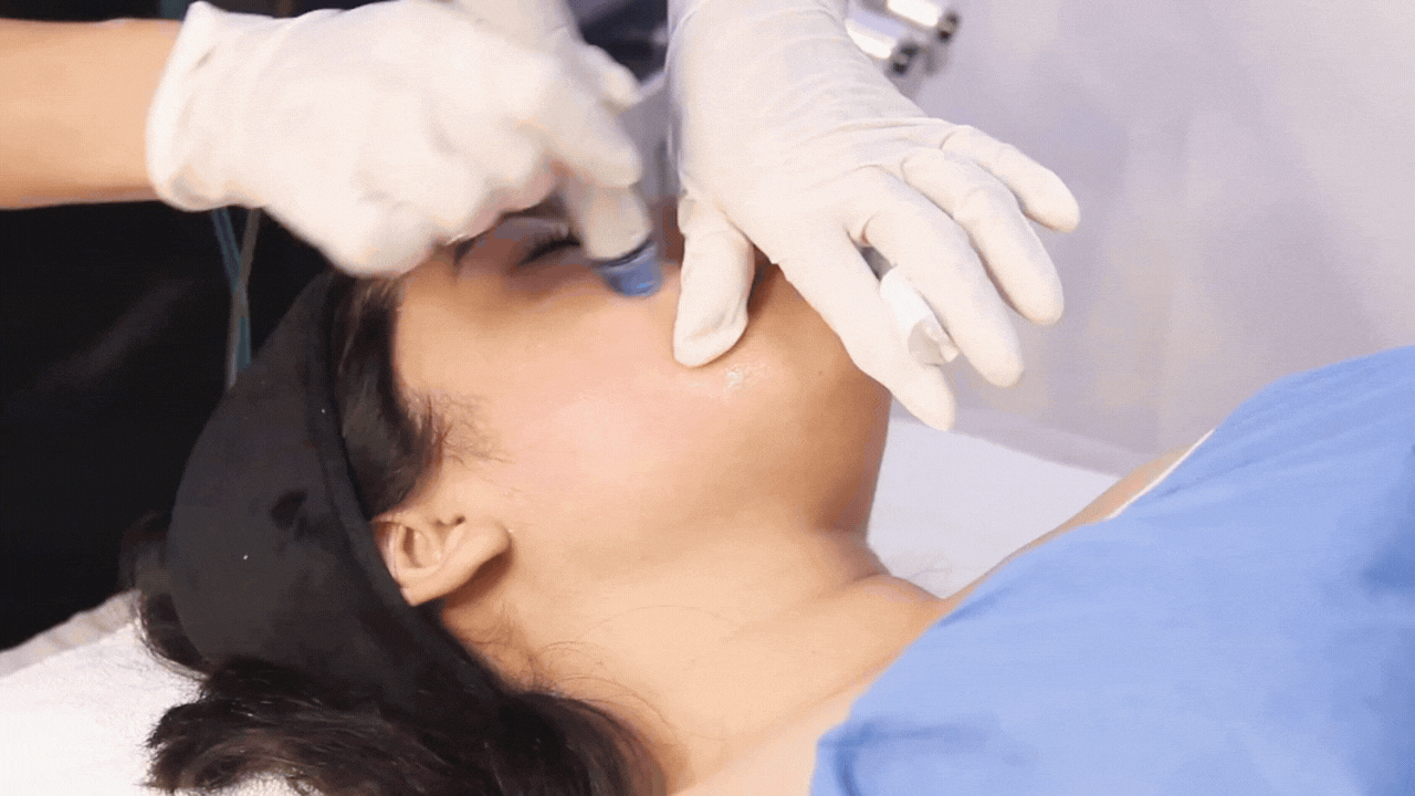 Hydra Facial for glowing, healthy skin