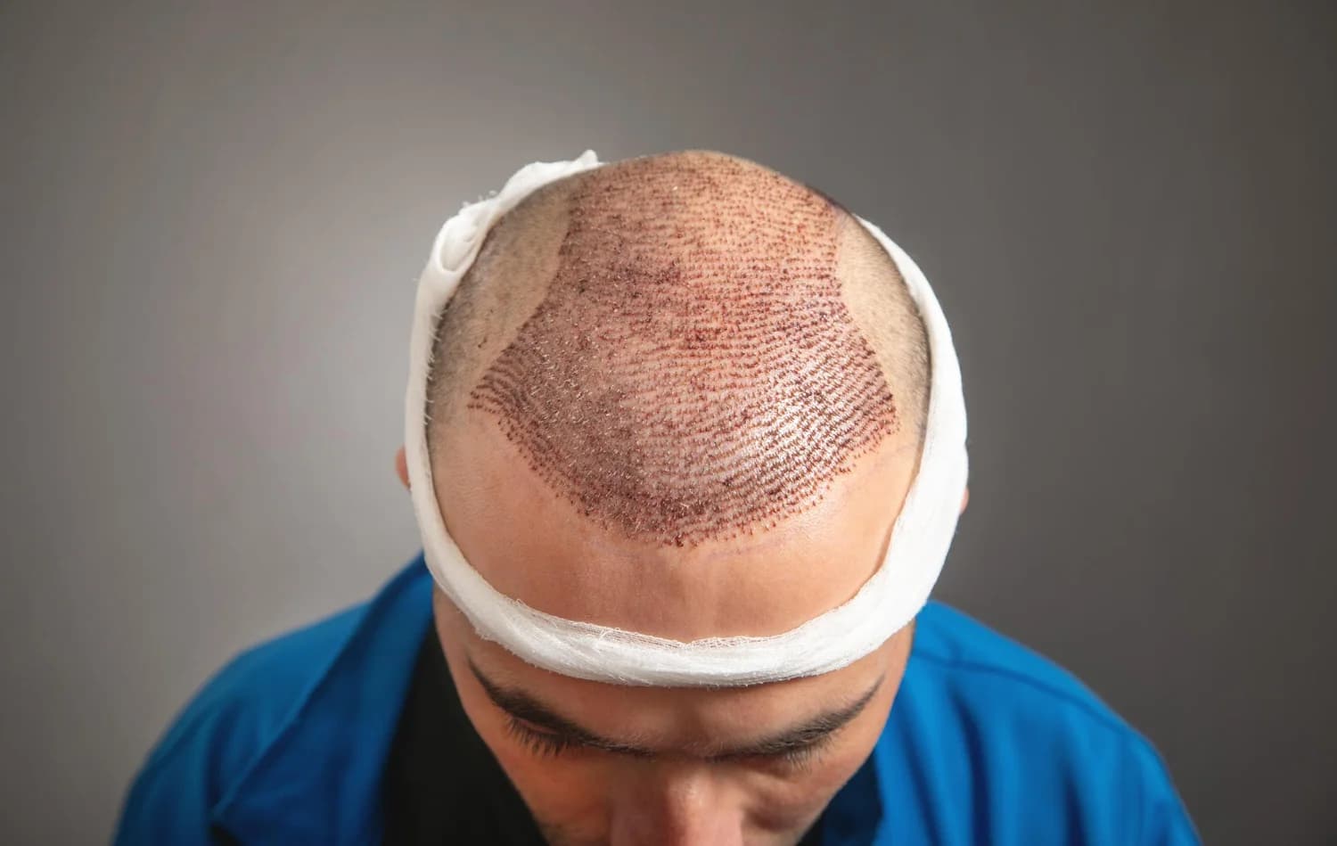 Hair loss