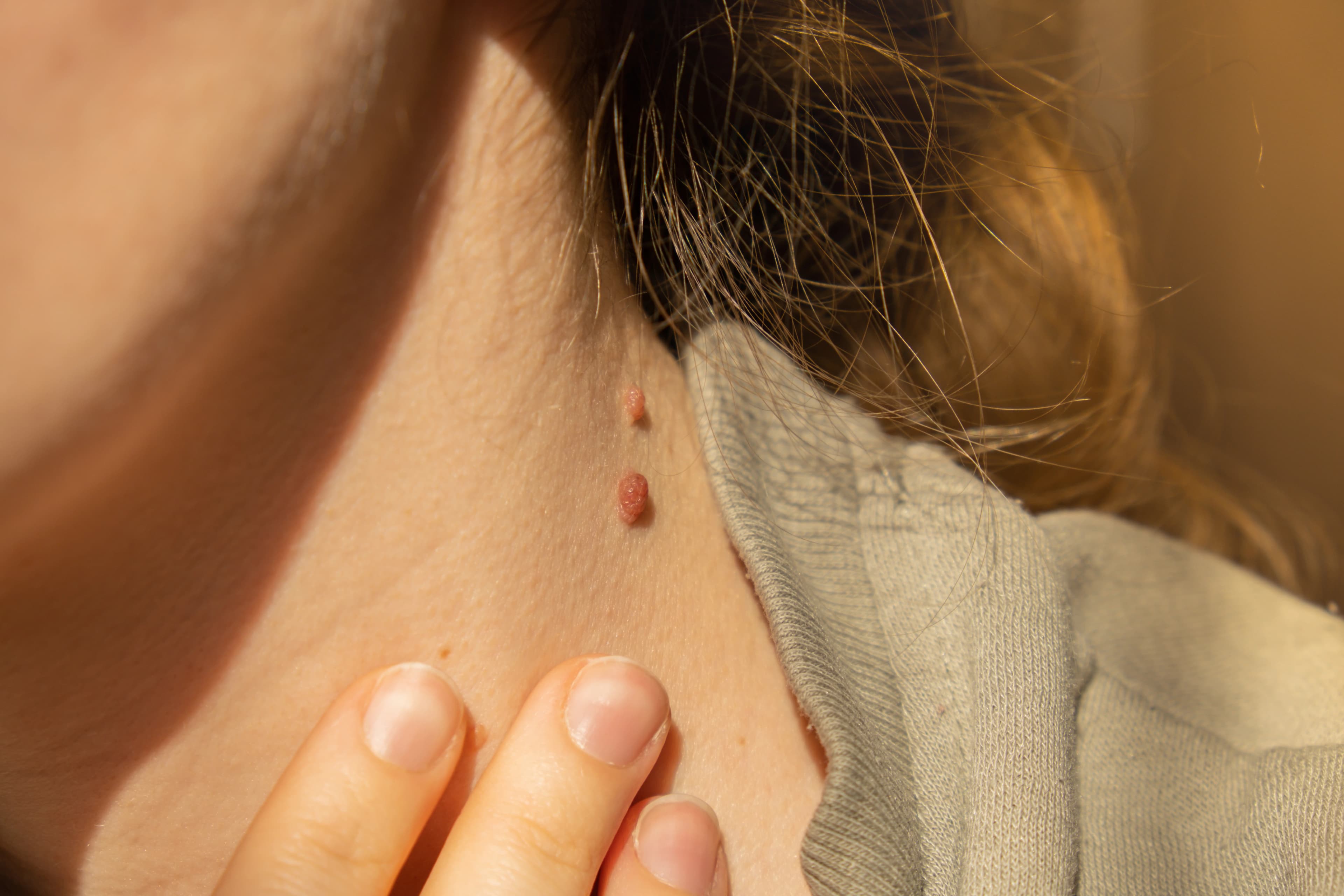 Moles, Warts & Skin Tags treatment