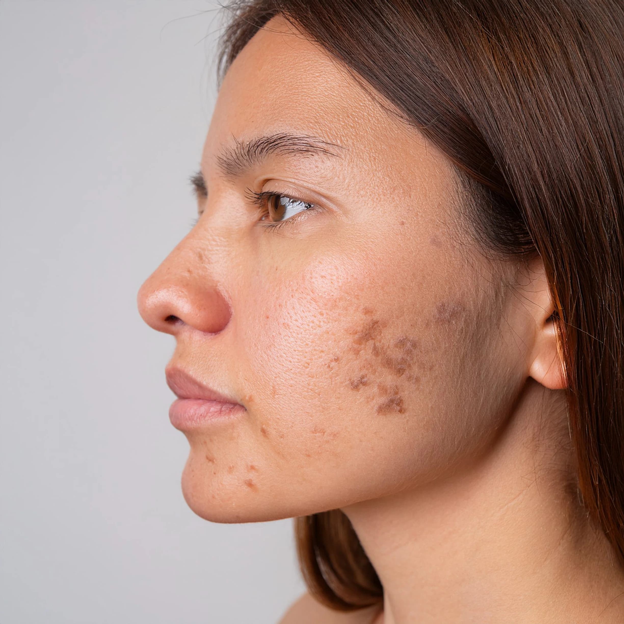 Pigmentation treatment