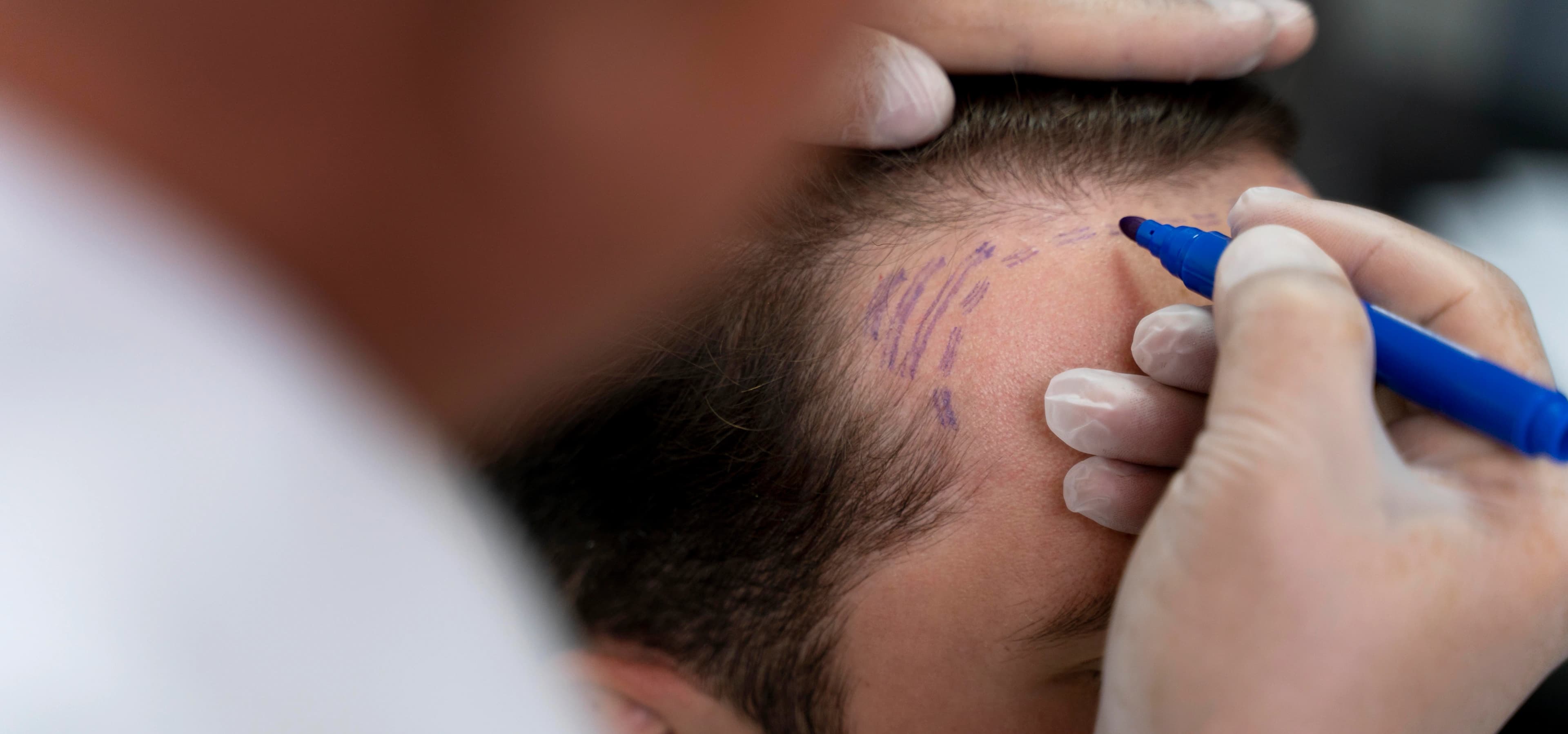 Hair Transplant Procedure