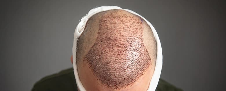 Hair Transplant Process