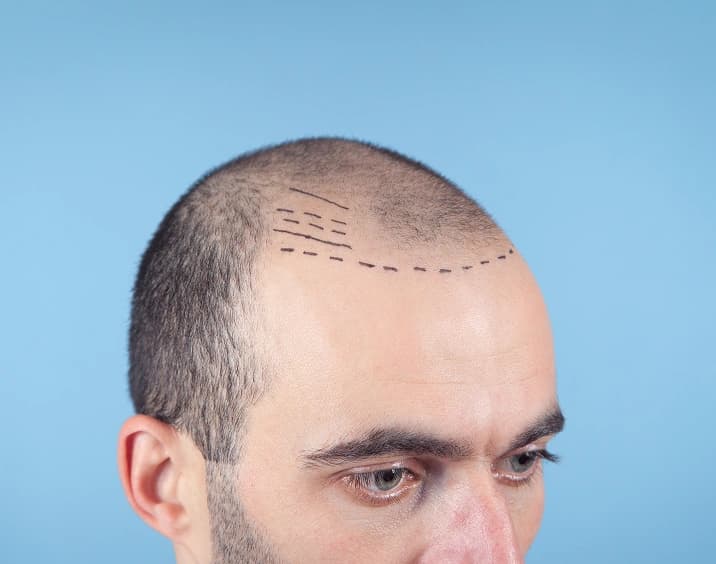 Hair Transplant Surgery