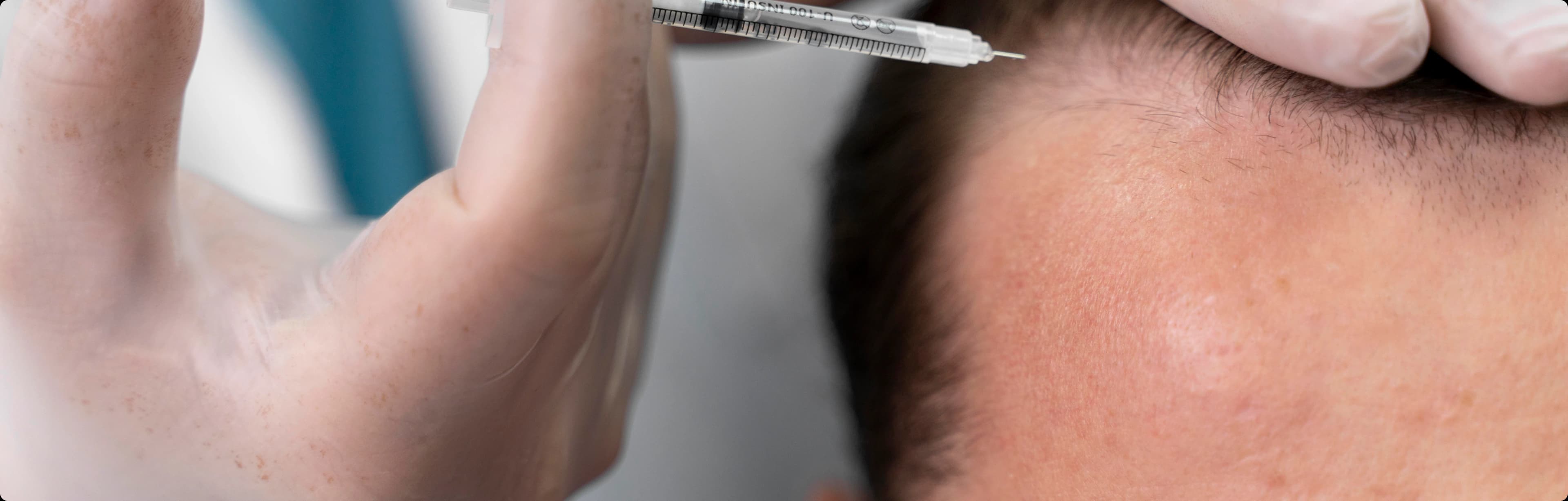 PRP treatment process