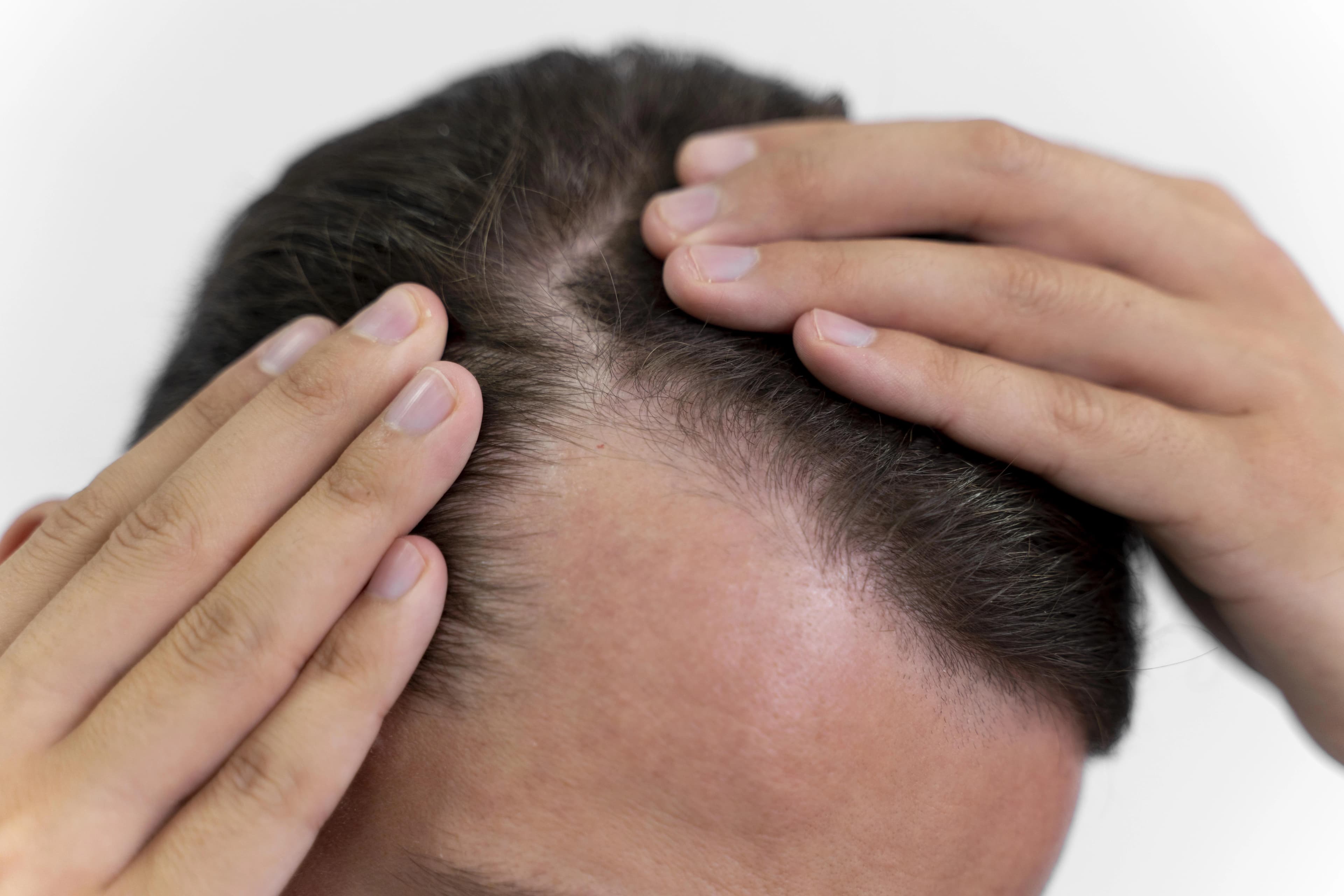 Hair Loss treatment