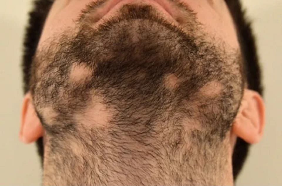 Patchy Beard treatment