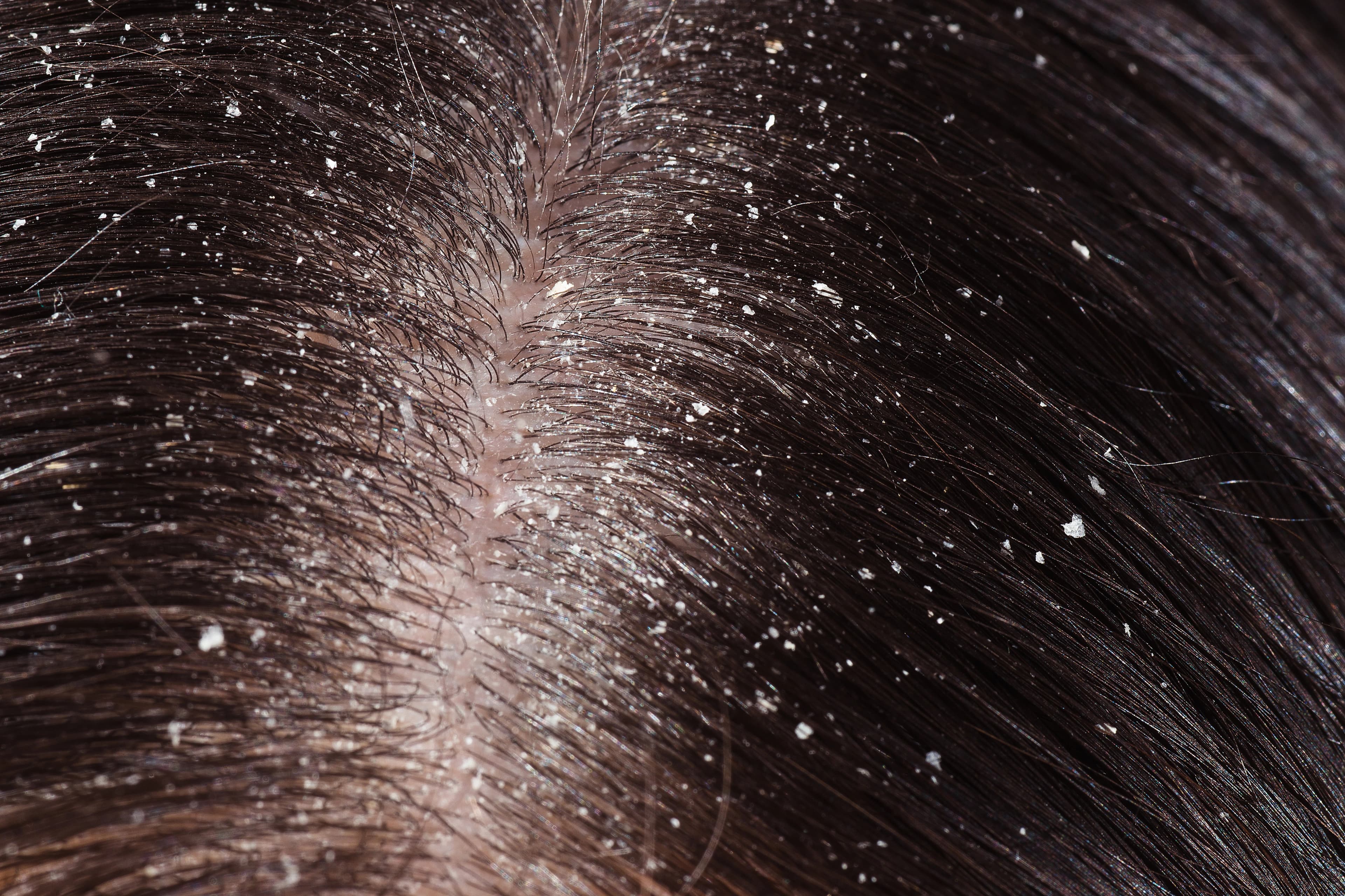 Dandruff treatment
