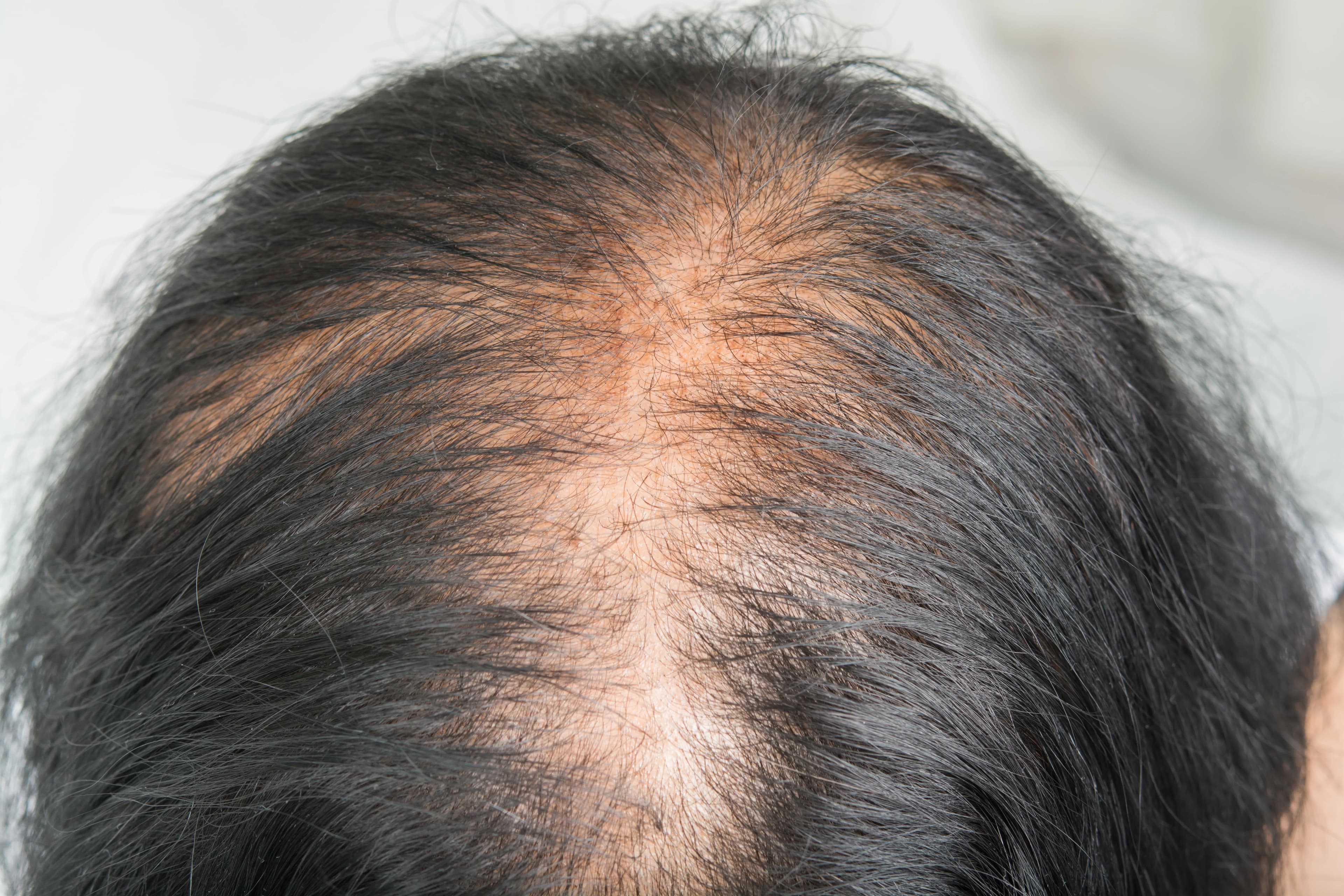 Hair Thinning treatment