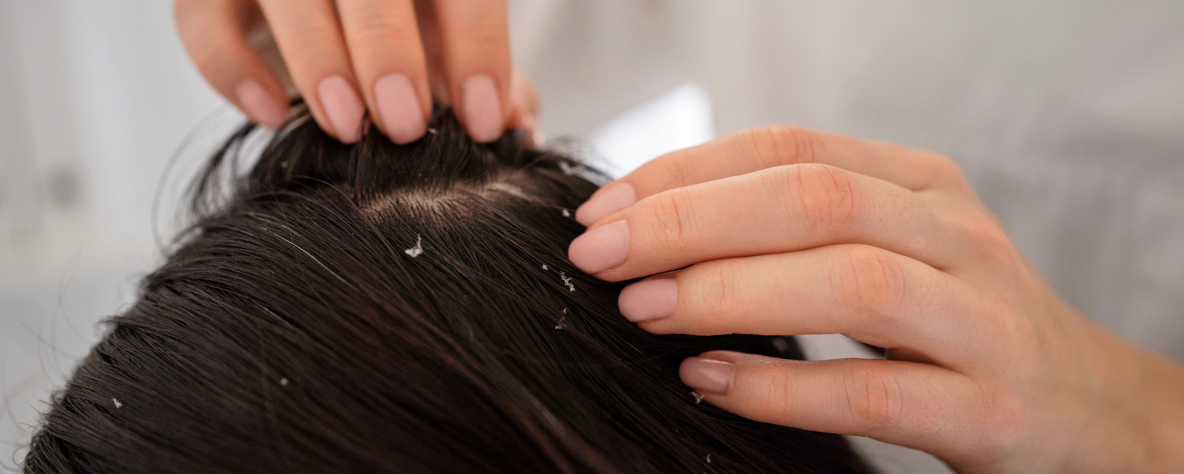 Dandruff Treatment