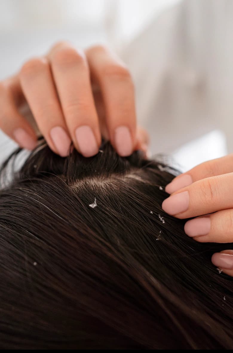 Dandruff Treatment
