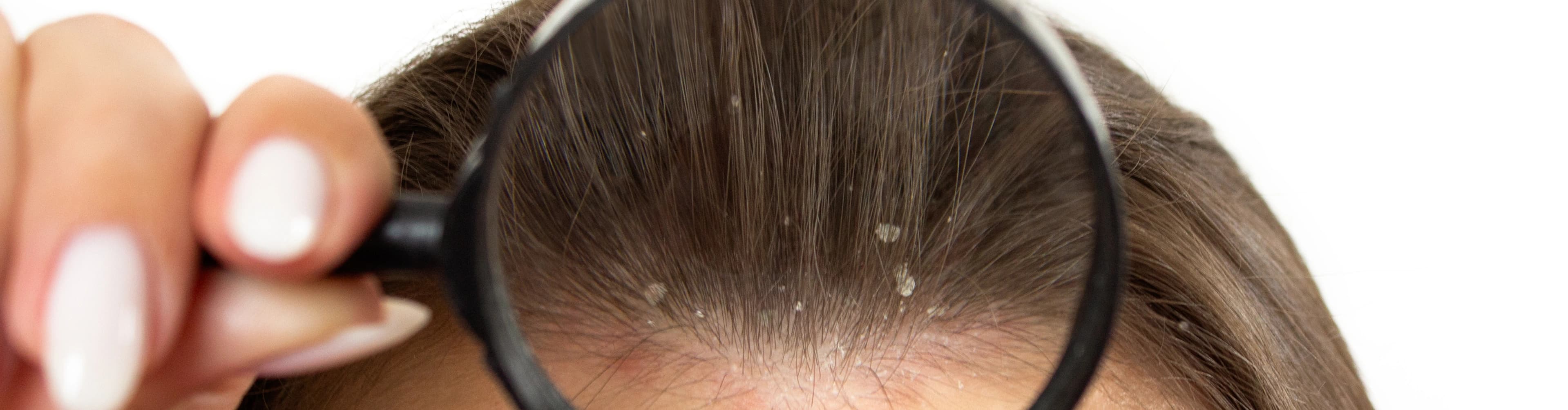 Dandruff Treatment Process