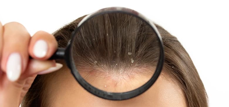 Dandruff Treatment Process
