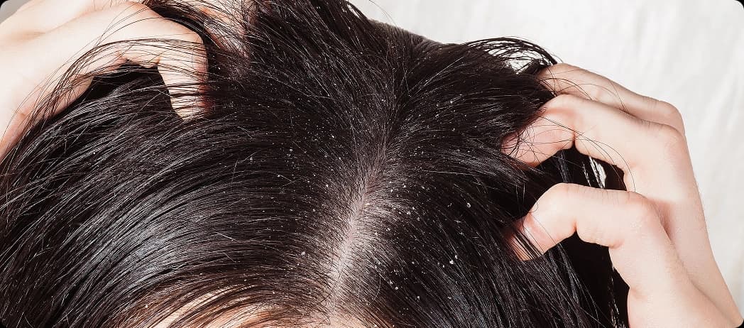 Dry Scalp & Flakes