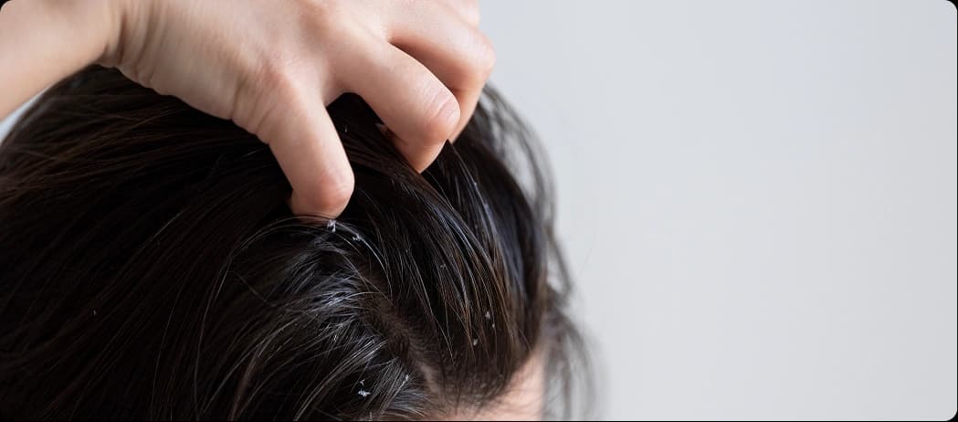Oily Scalp with Itchy Flakes