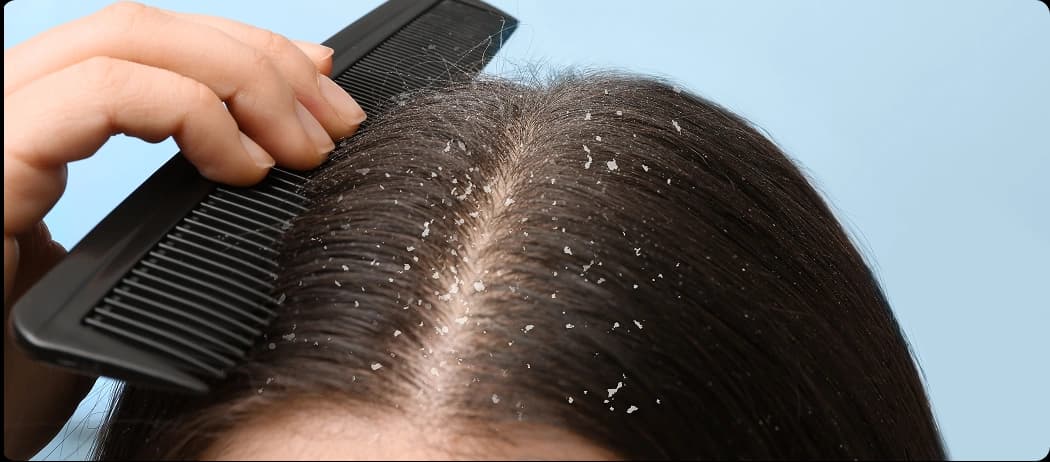 Recurring Dandruff
