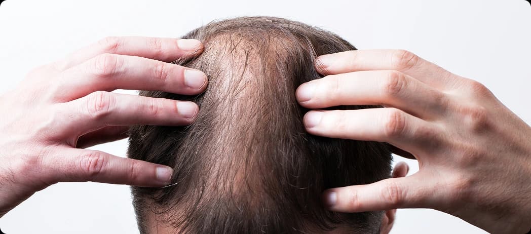Male Pattern Baldness