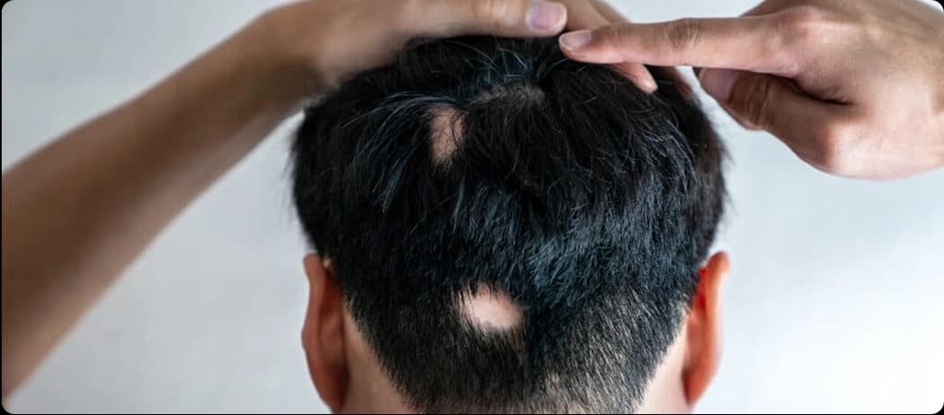 Alopecia Areata