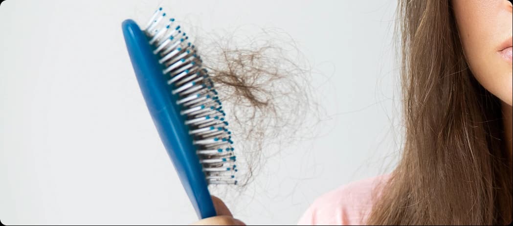 Alopecia Areata