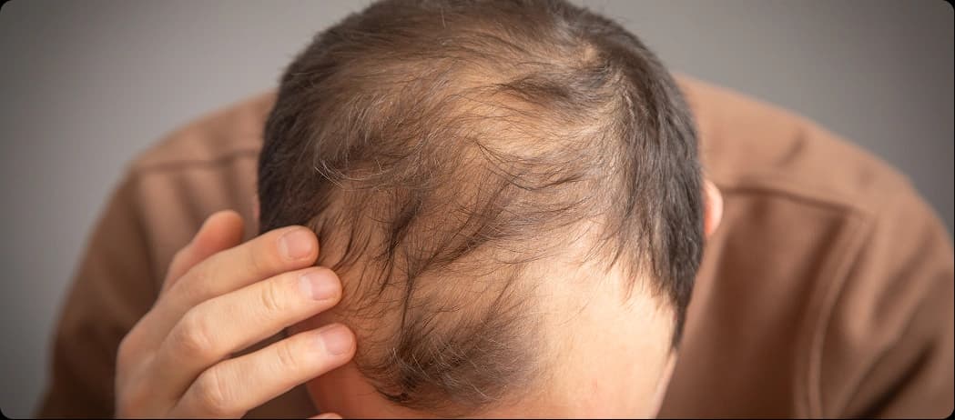Scalp & Hairfall Issues
