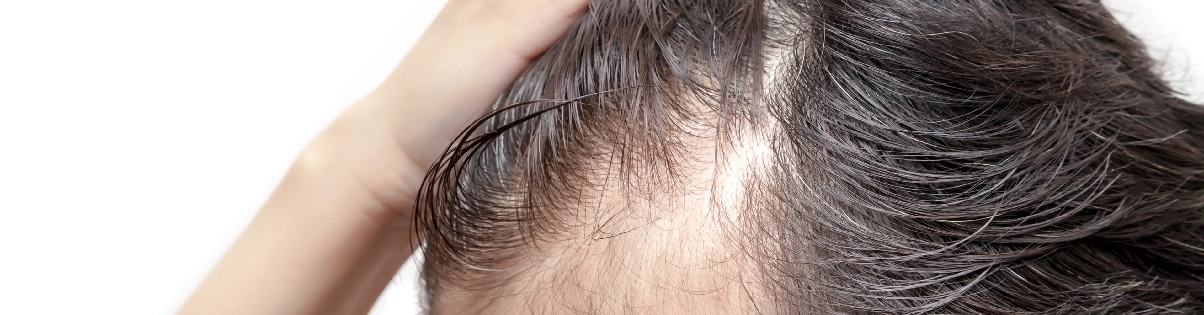 Hair Thinning Diagnosis & Treatment