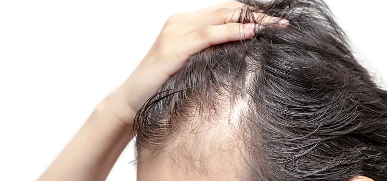 Hair Thinning Diagnosis & Treatment