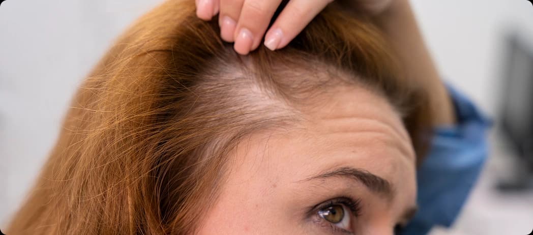 Hair Thinning in Women