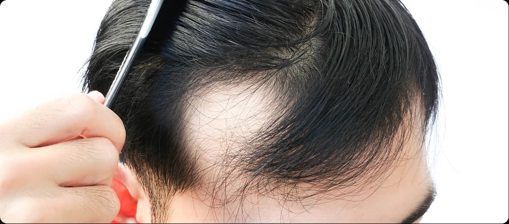Hair Thinning in Men